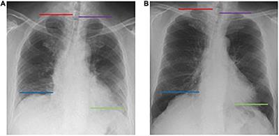 Quantitative evaluation of diaphragmatic motion during forced breathing in chronic obstructive pulmonary disease patients using dynamic chest radiography